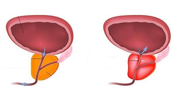 Gesunde und entzündete Prostata mit Prostatitis