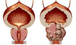 Gesunde und ungesunde Prostata