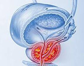 Entzündung der Prostata mit Prostatitis